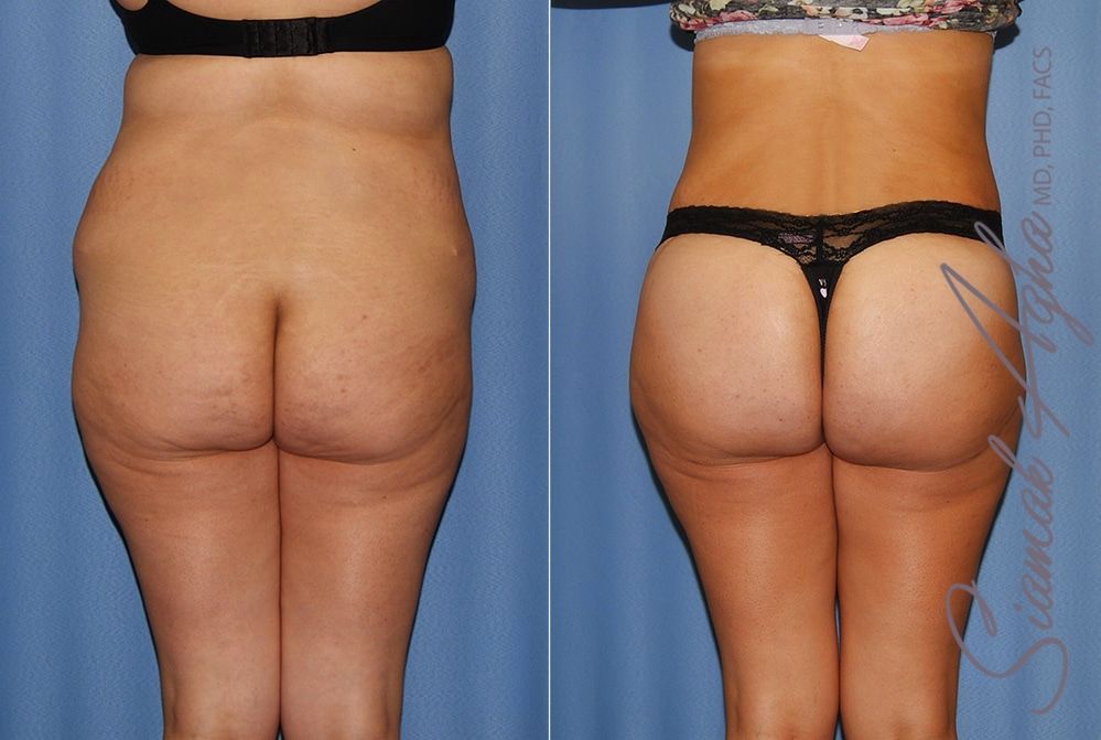 Brazilian Butt Lift Before & After