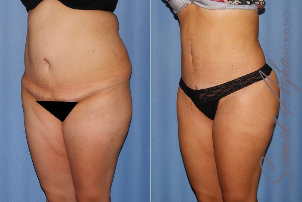 Brazilian Butt Lift Before & After