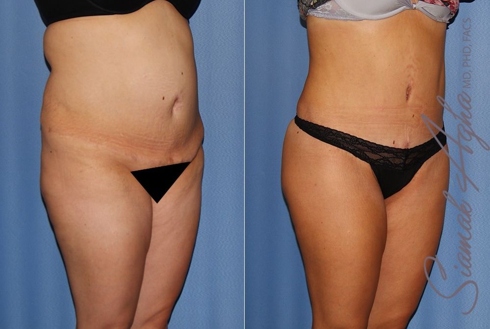 Brazilian Butt Lift Before & After