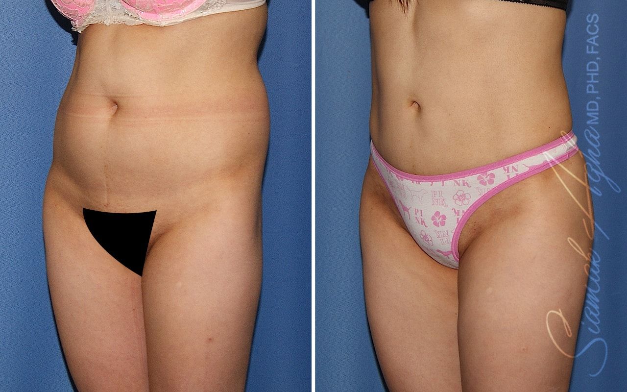 Brazilian Butt Lift Before & After