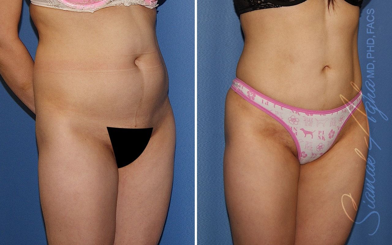 Brazilian Butt Lift Before & After