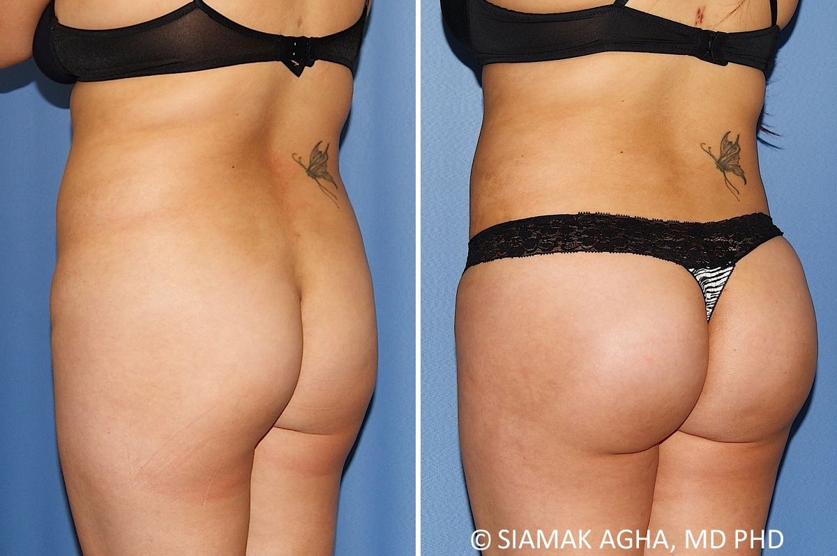 Brazilian Butt Lift Before & After