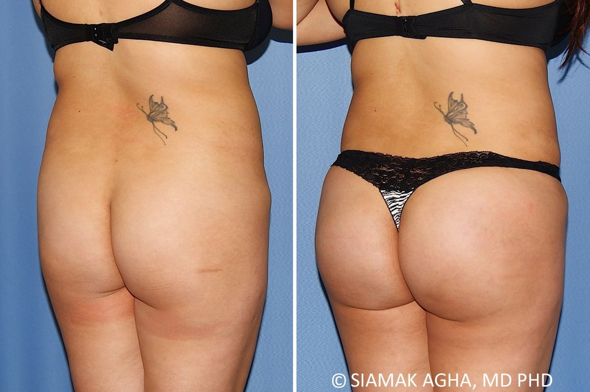 Brazilian Butt Lift Before & After