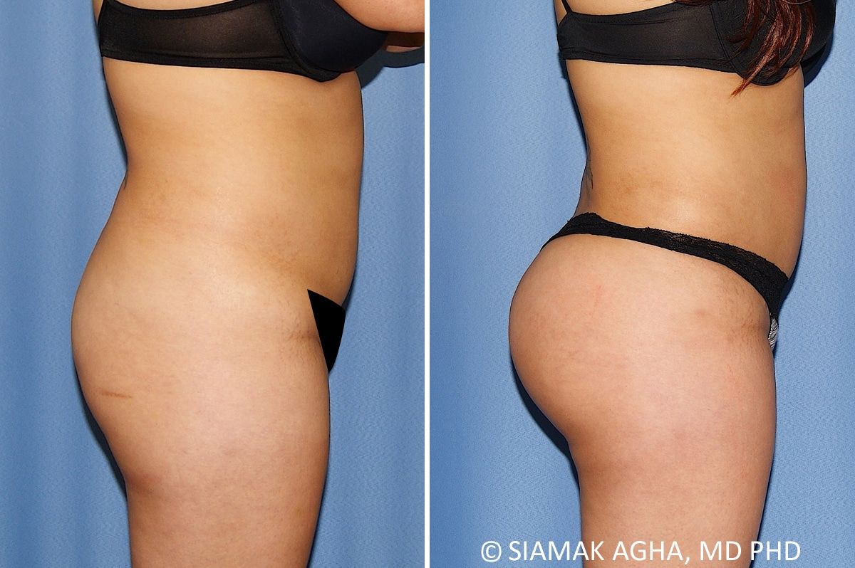 Brazilian Butt Lift Before & After