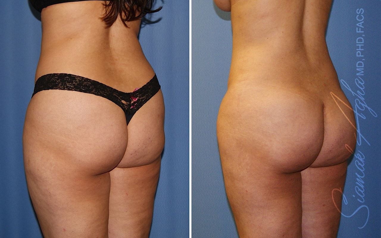 Brazilian Butt Lift Before & After