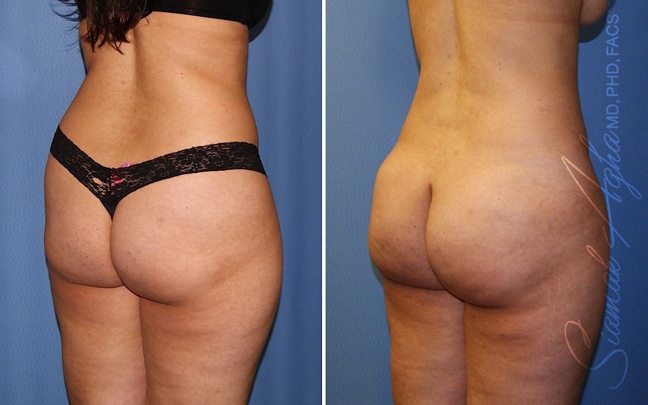Brazilian Butt Lift Before & After
