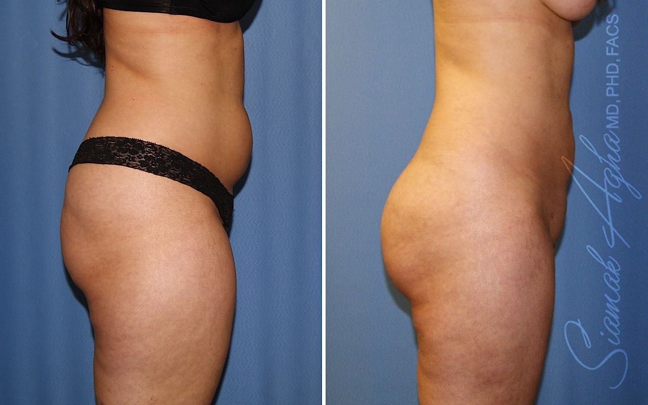 Brazilian Butt Lift Before & After