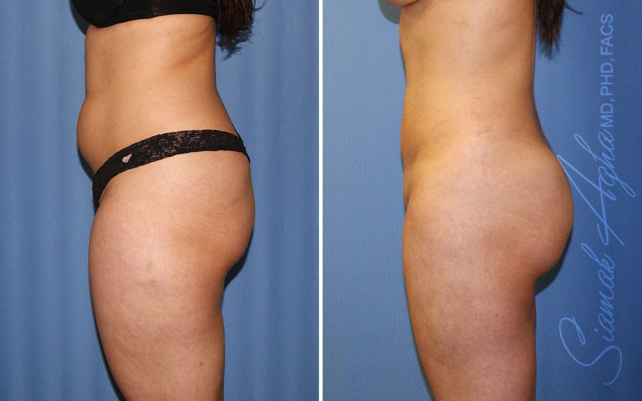 Brazilian Butt Lift Before & After