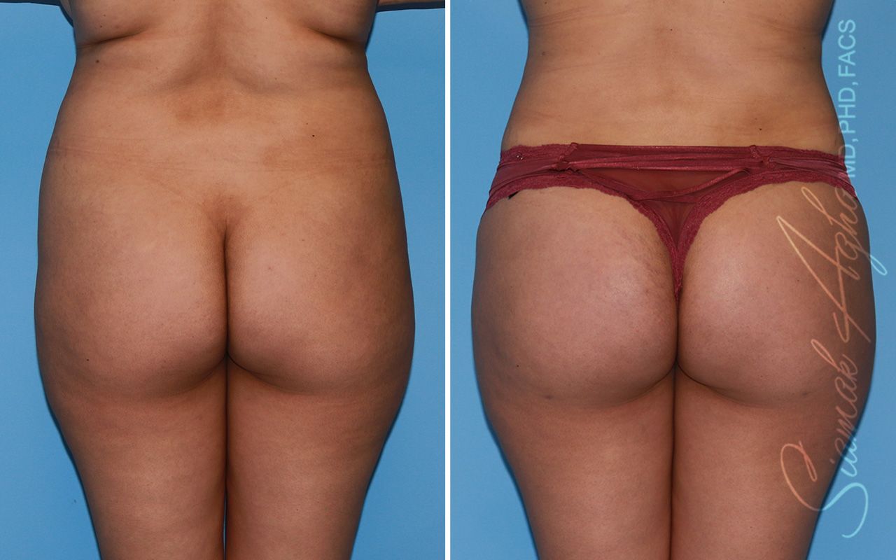 Brazilian Butt Lift Before & After