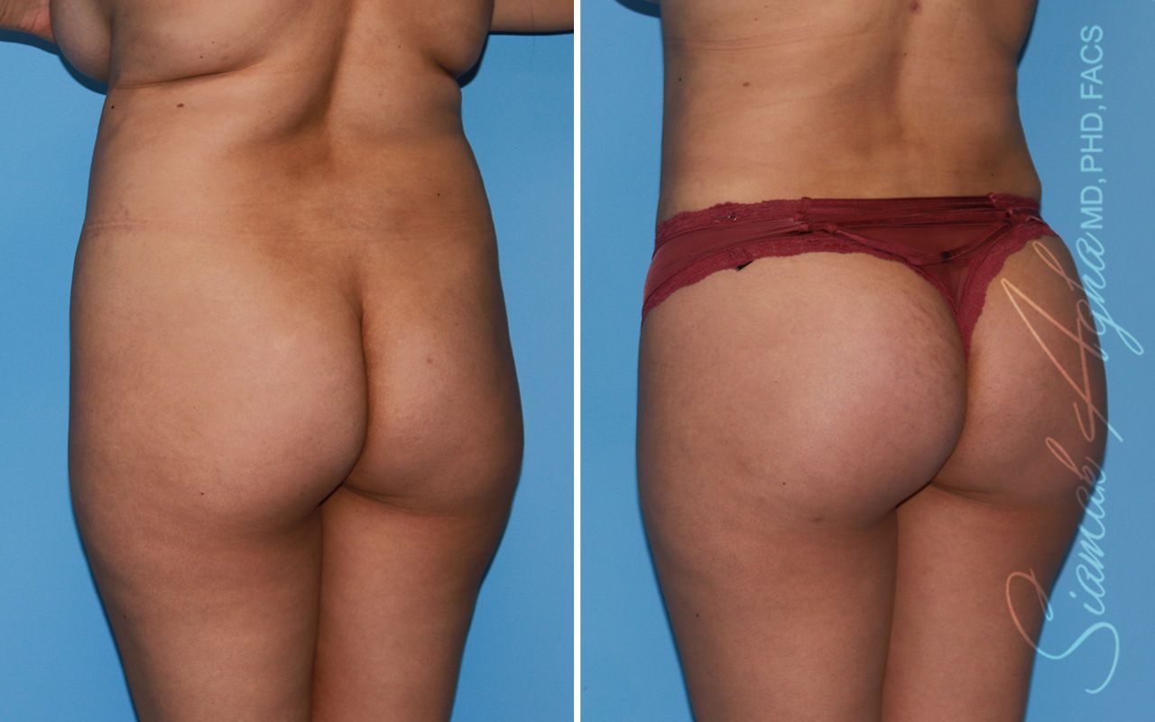 Brazilian Butt Lift Before & After