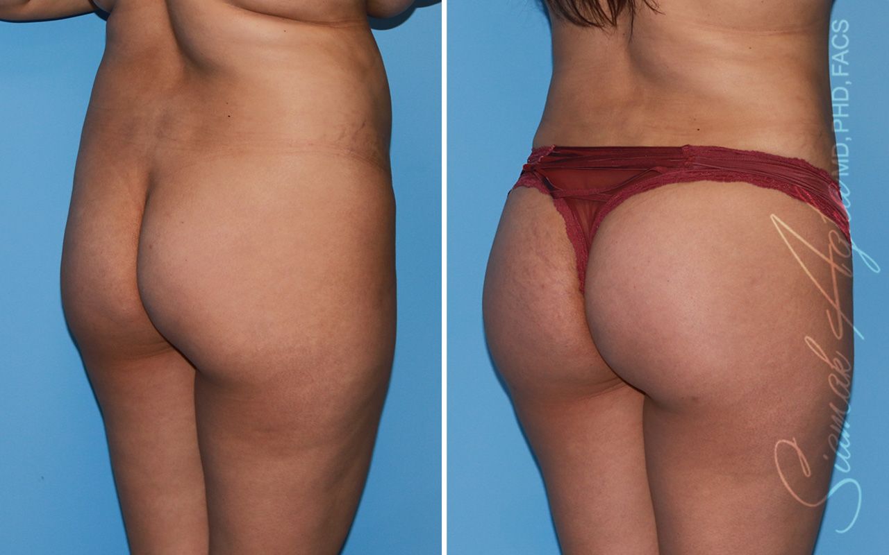 Brazilian Butt Lift Before & After