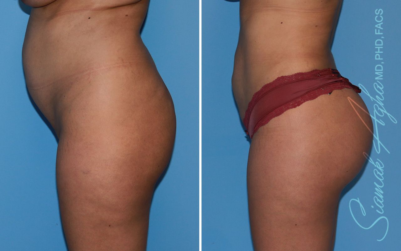 Brazilian Butt Lift Before & After