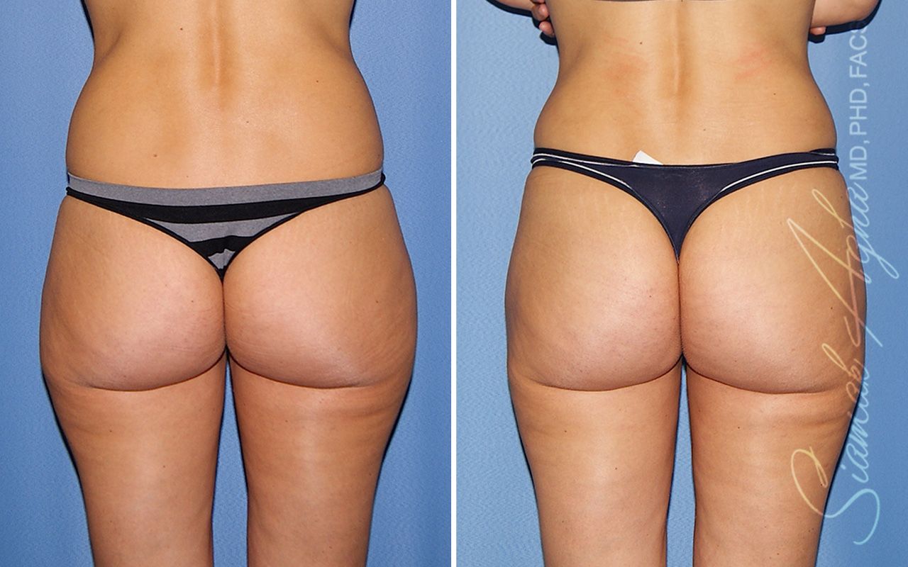 Brazilian Butt Lift Before & After