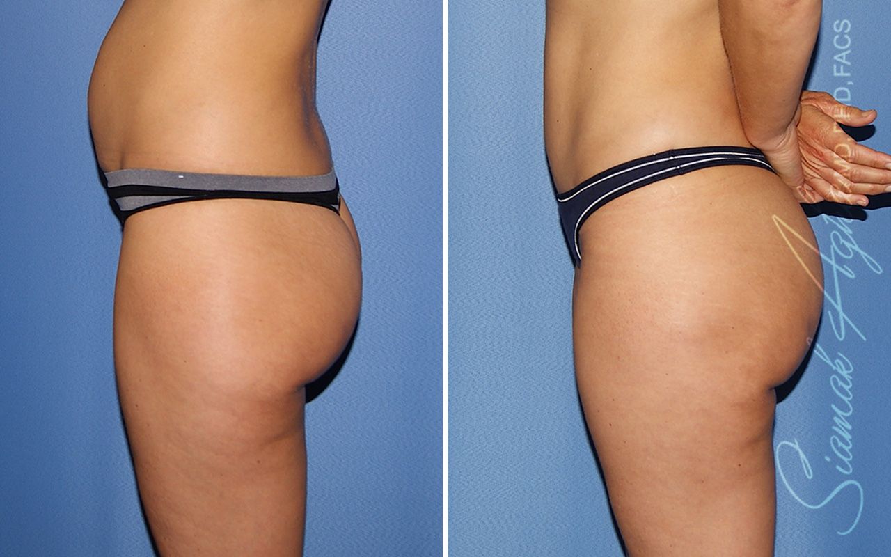 Brazilian Butt Lift Before & After