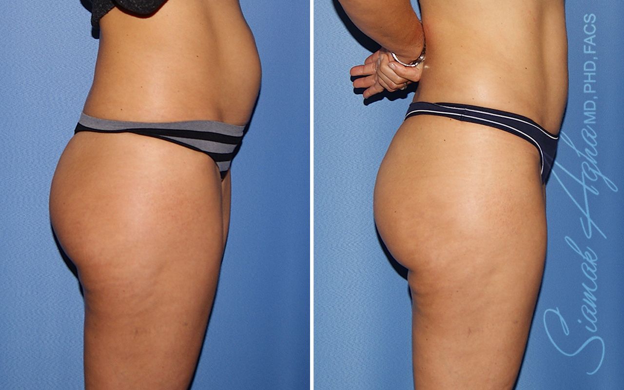 Brazilian Butt Lift Before & After