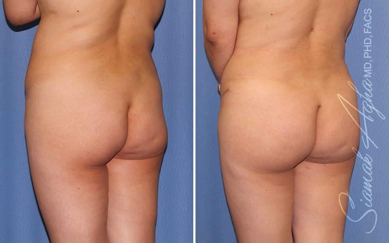 Brazilian Butt Lift Before & After