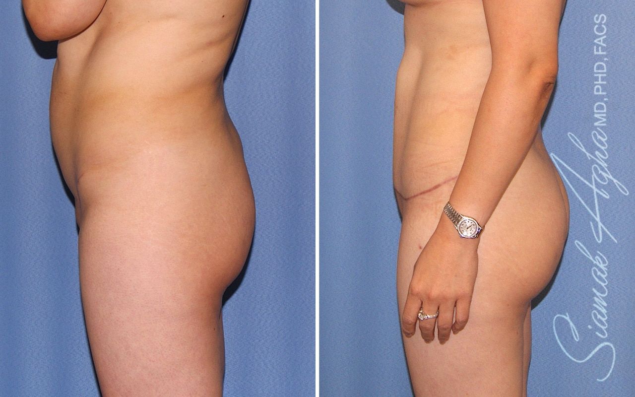 Brazilian Butt Lift Before & After