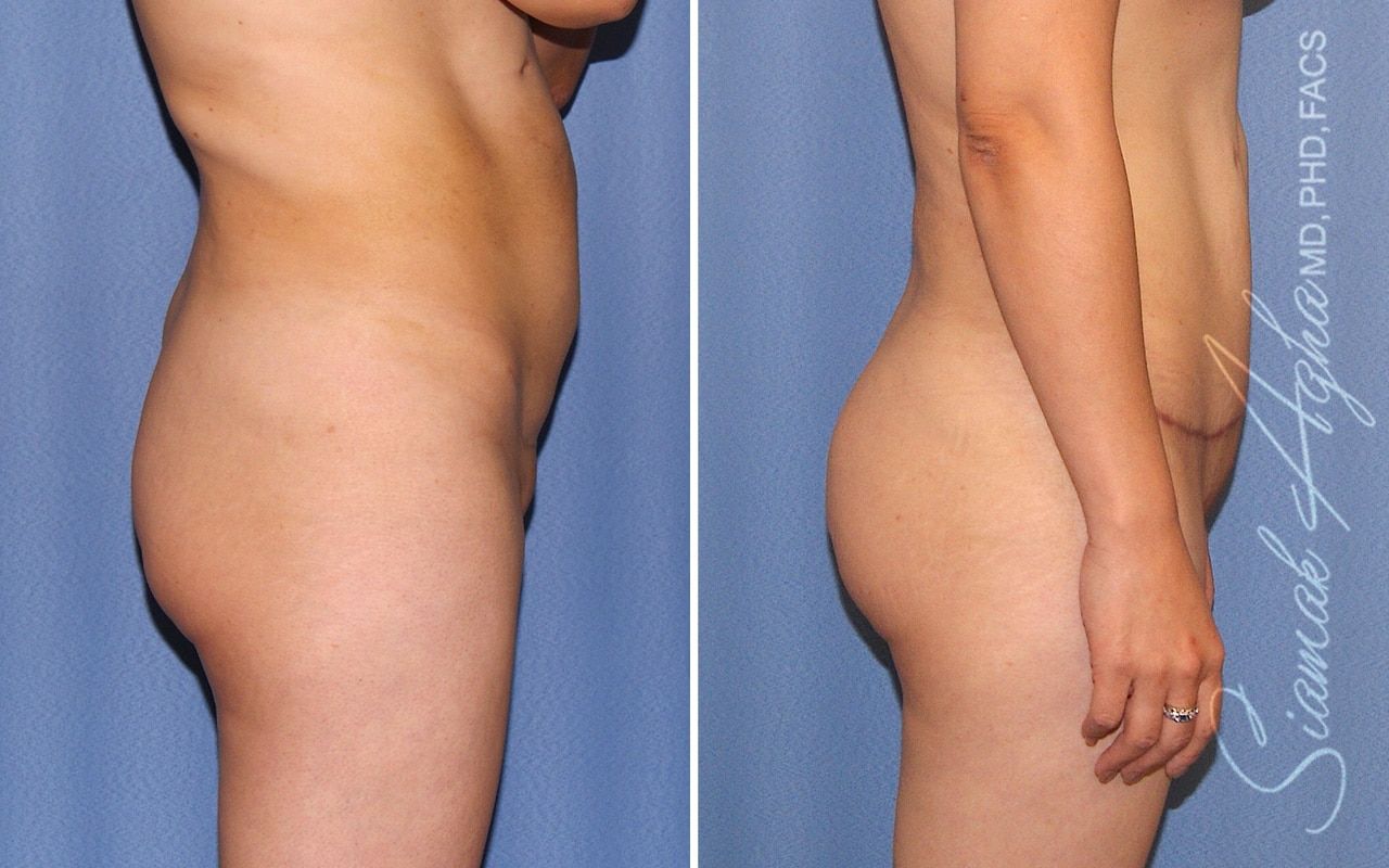Brazilian Butt Lift Before & After