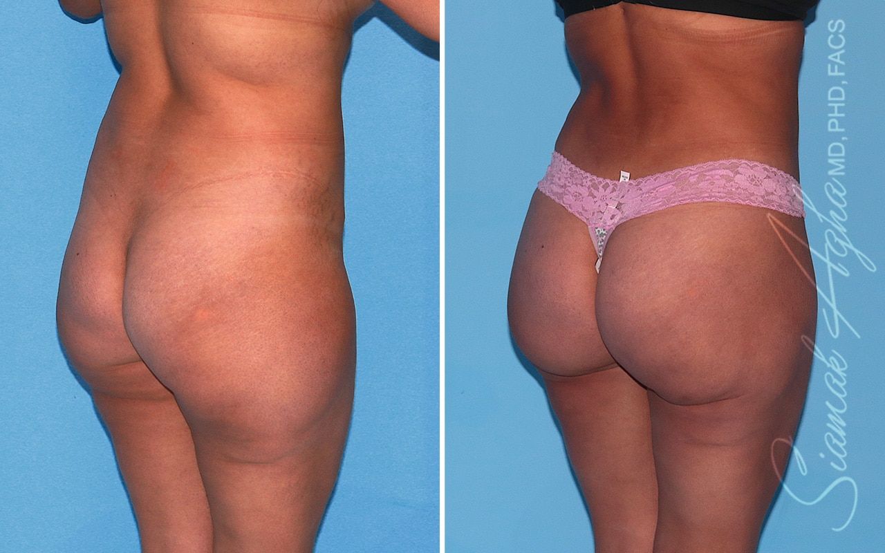 Brazilian Butt Lift Before & After