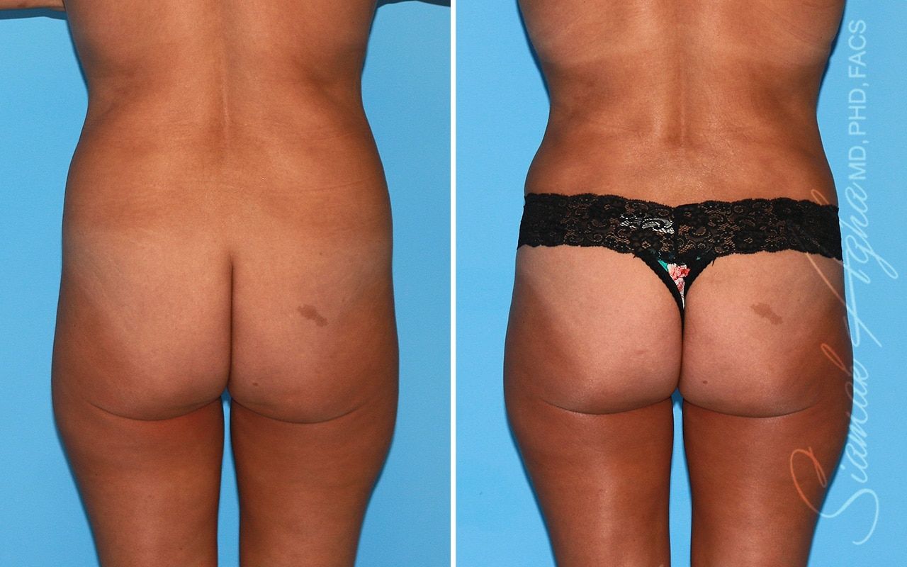 Brazilian Butt Lift Before & After