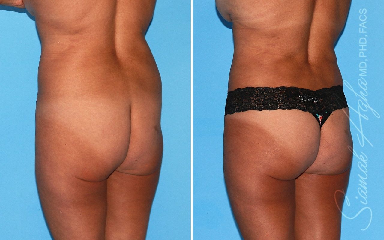 Brazilian Butt Lift Before & After
