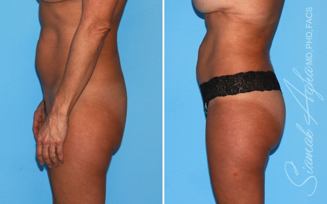 Brazilian Butt Lift Before & After