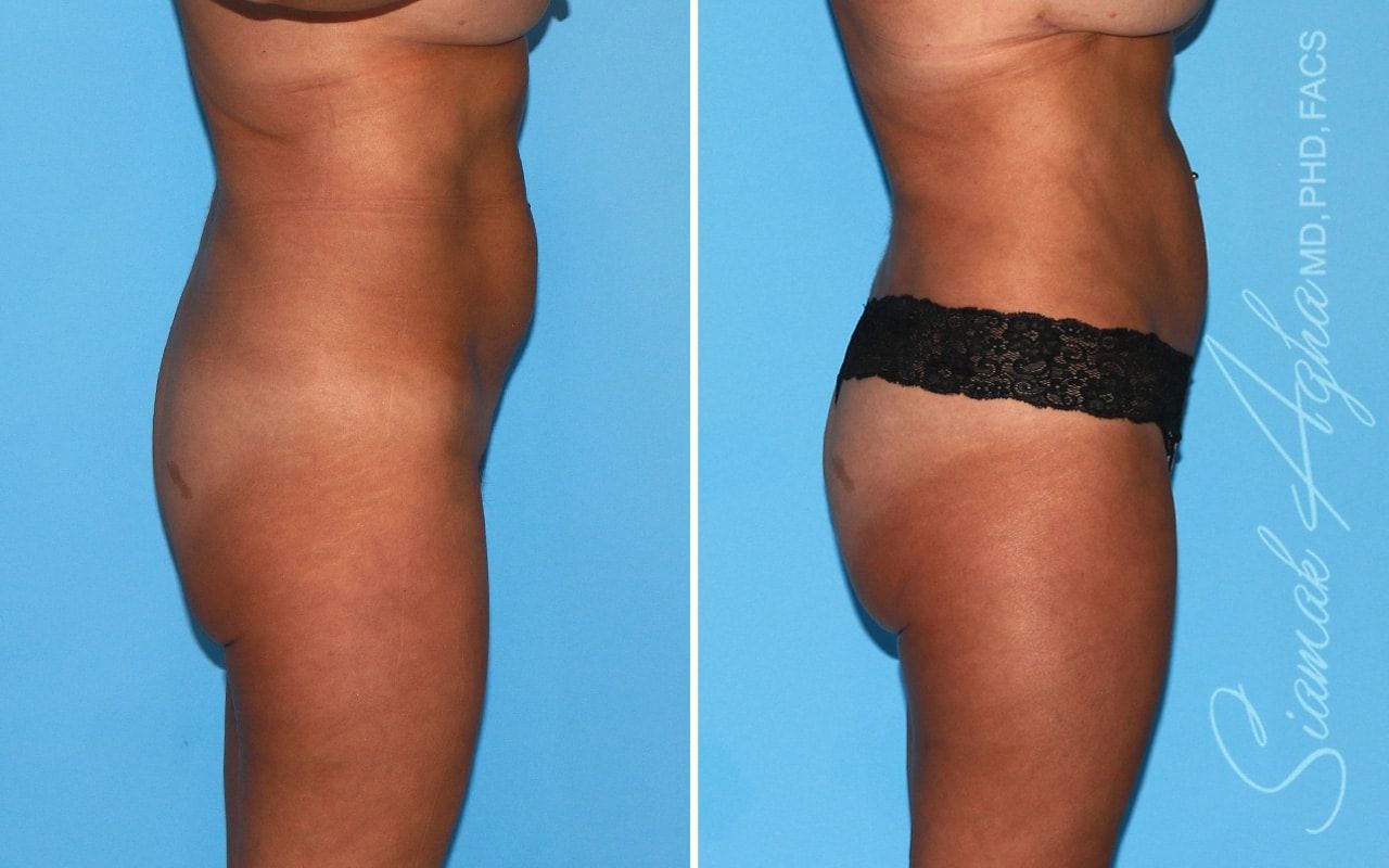 Brazilian Butt Lift Before & After