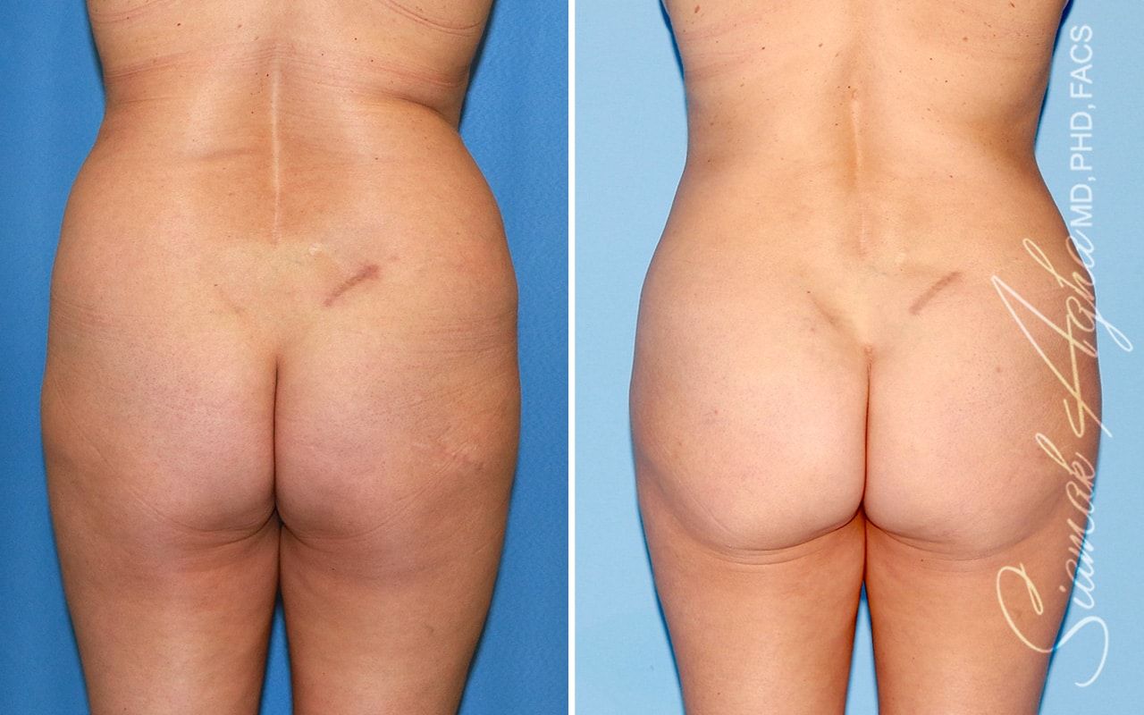 Brazilian Butt Lift Before & After