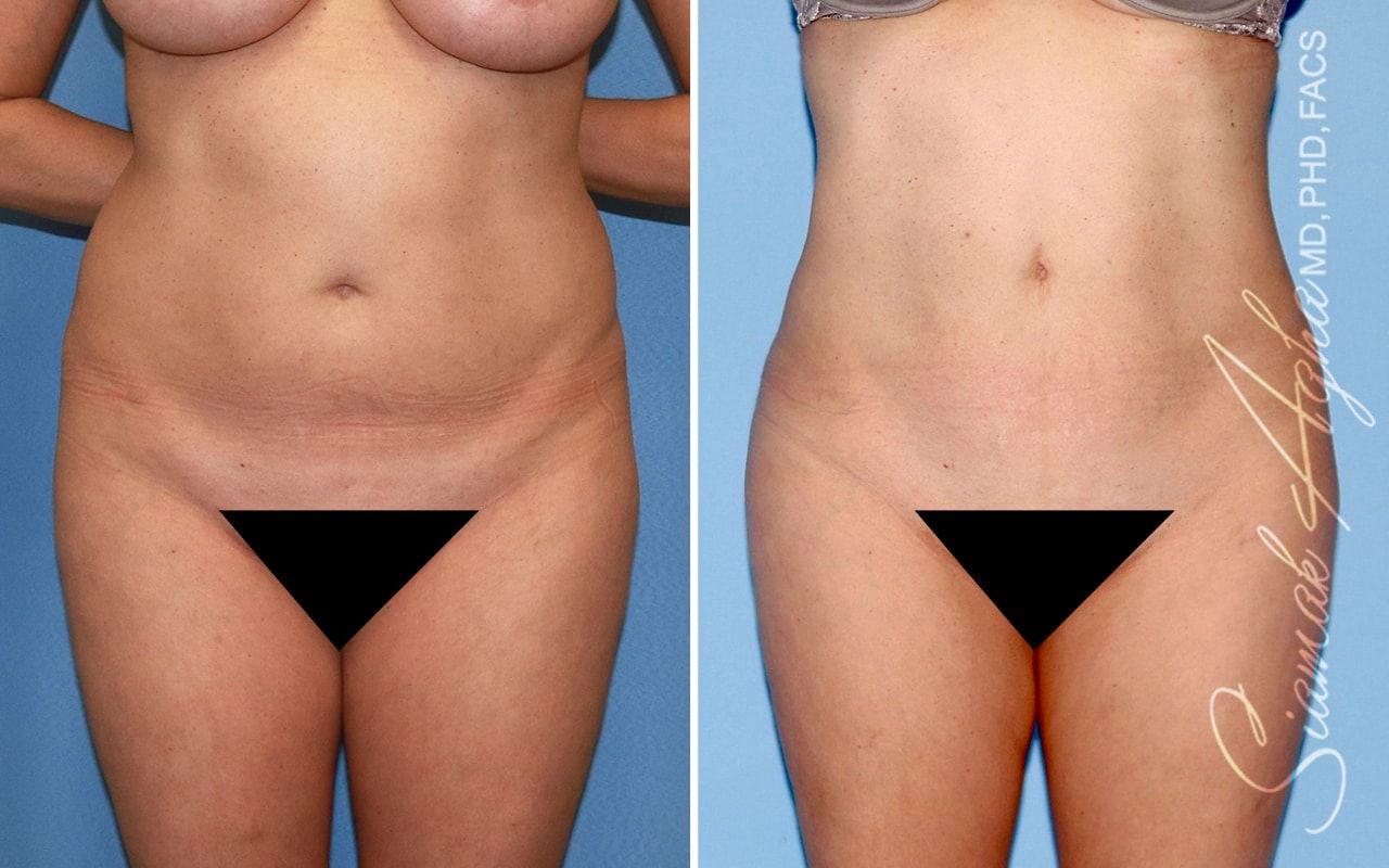 Brazilian Butt Lift Before & After