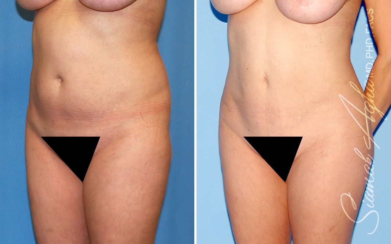 Brazilian Butt Lift Before & After