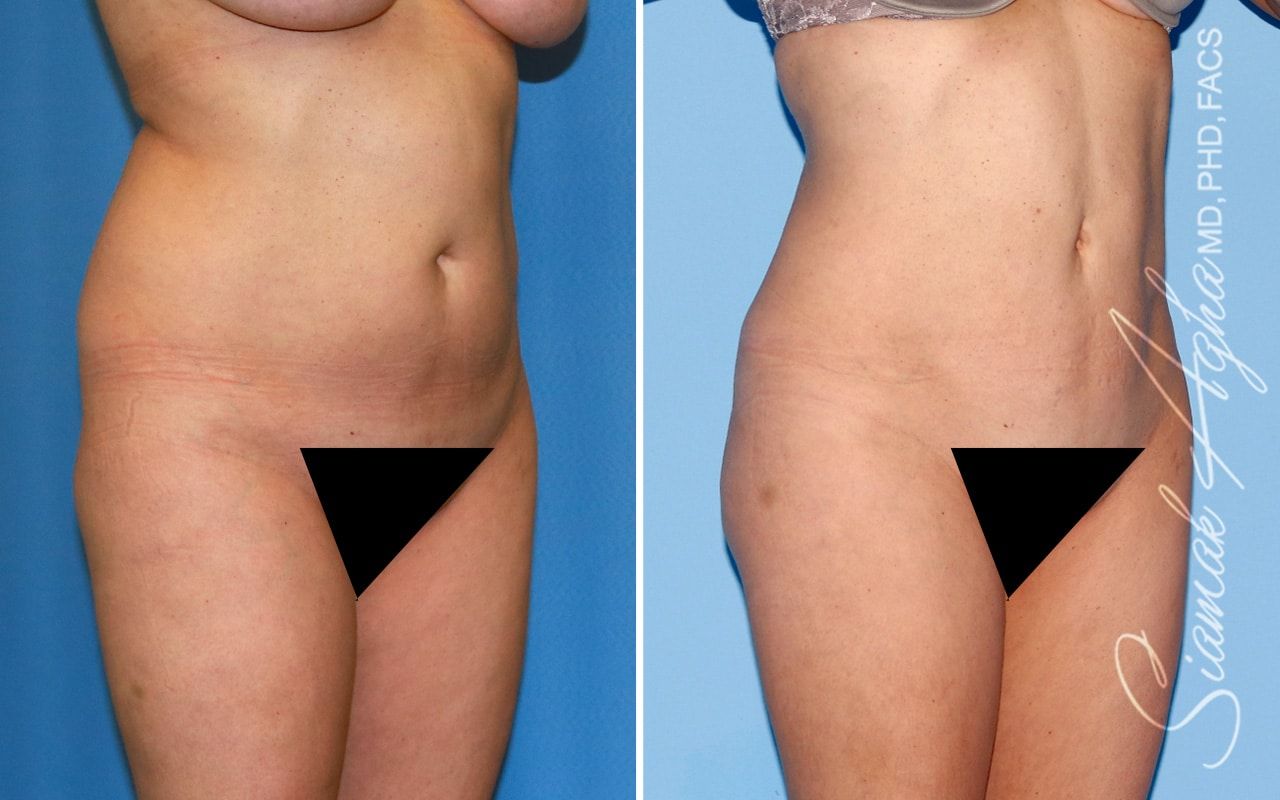 Brazilian Butt Lift Before & After