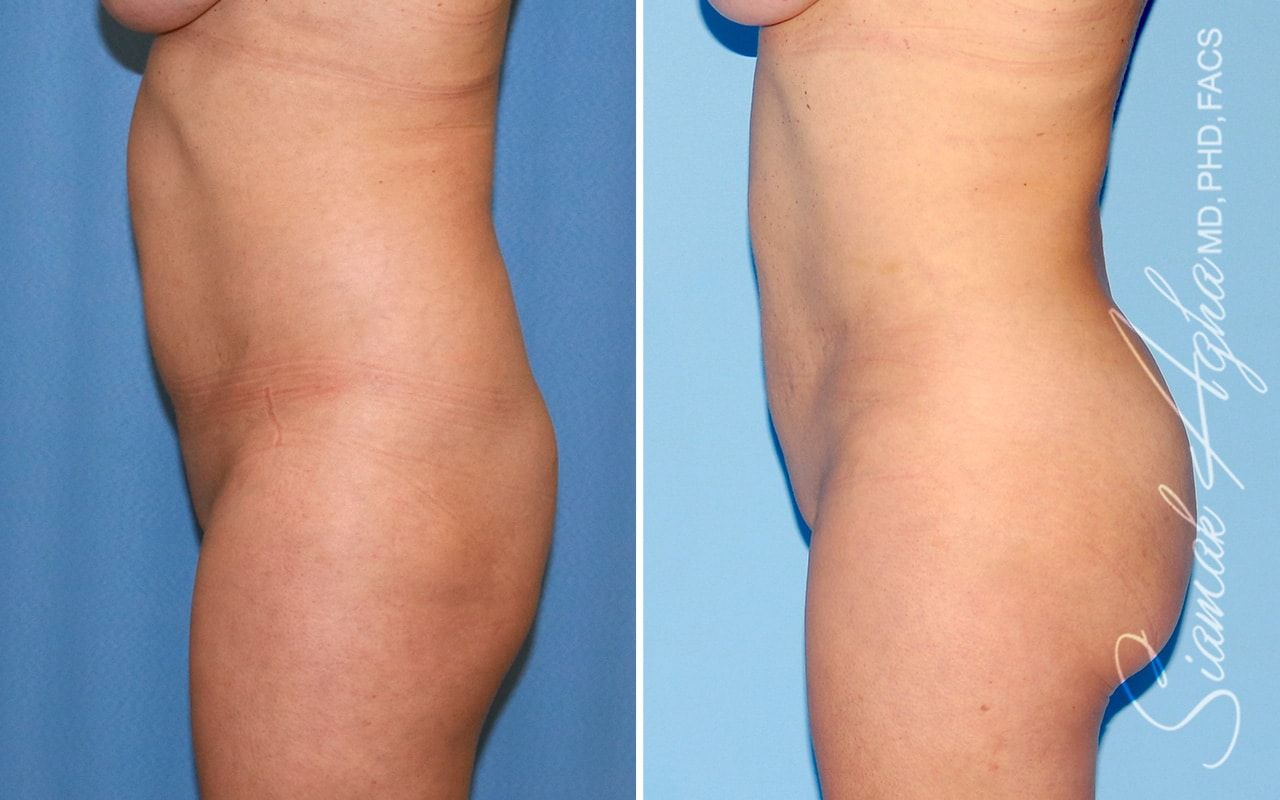 Brazilian Butt Lift Before & After