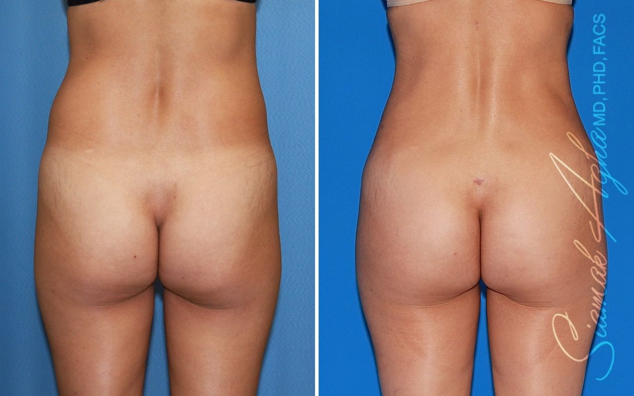 Brazilian Butt Lift Before & After