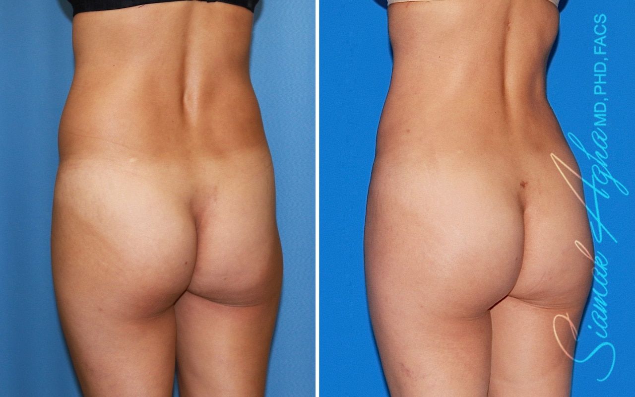 Brazilian Butt Lift Before & After