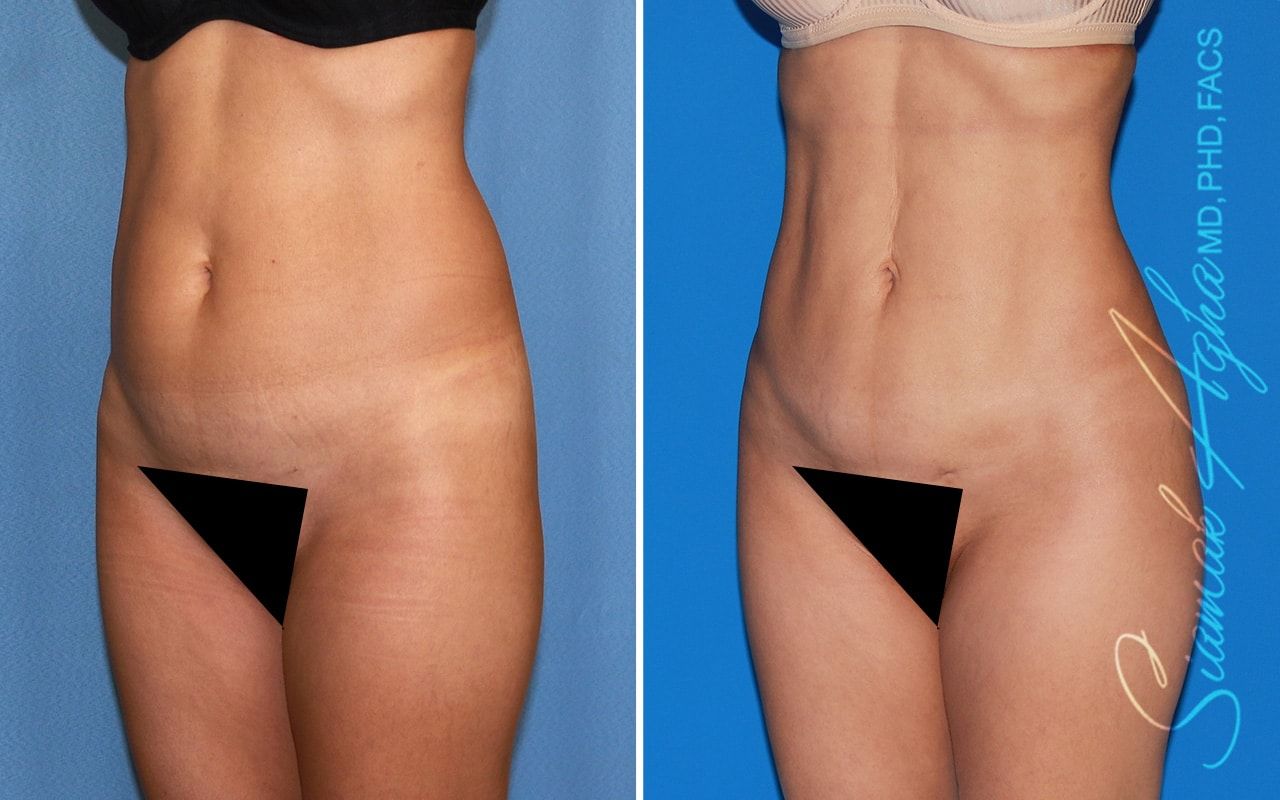 Brazilian Butt Lift Before & After