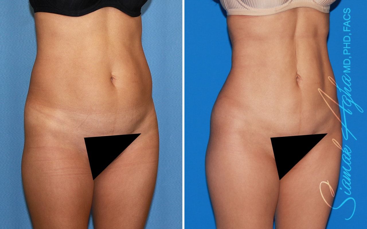 Brazilian Butt Lift Before & After