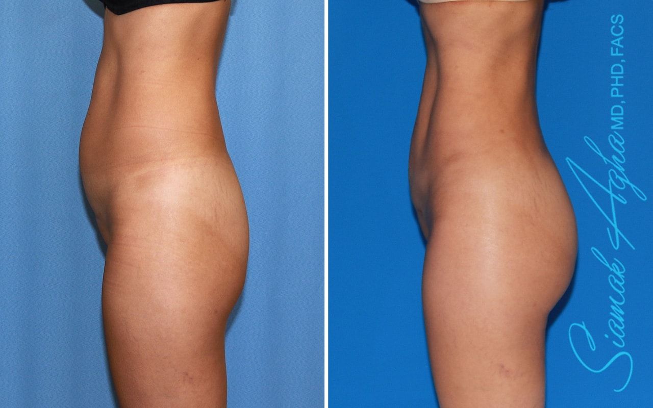 Brazilian Butt Lift Before & After