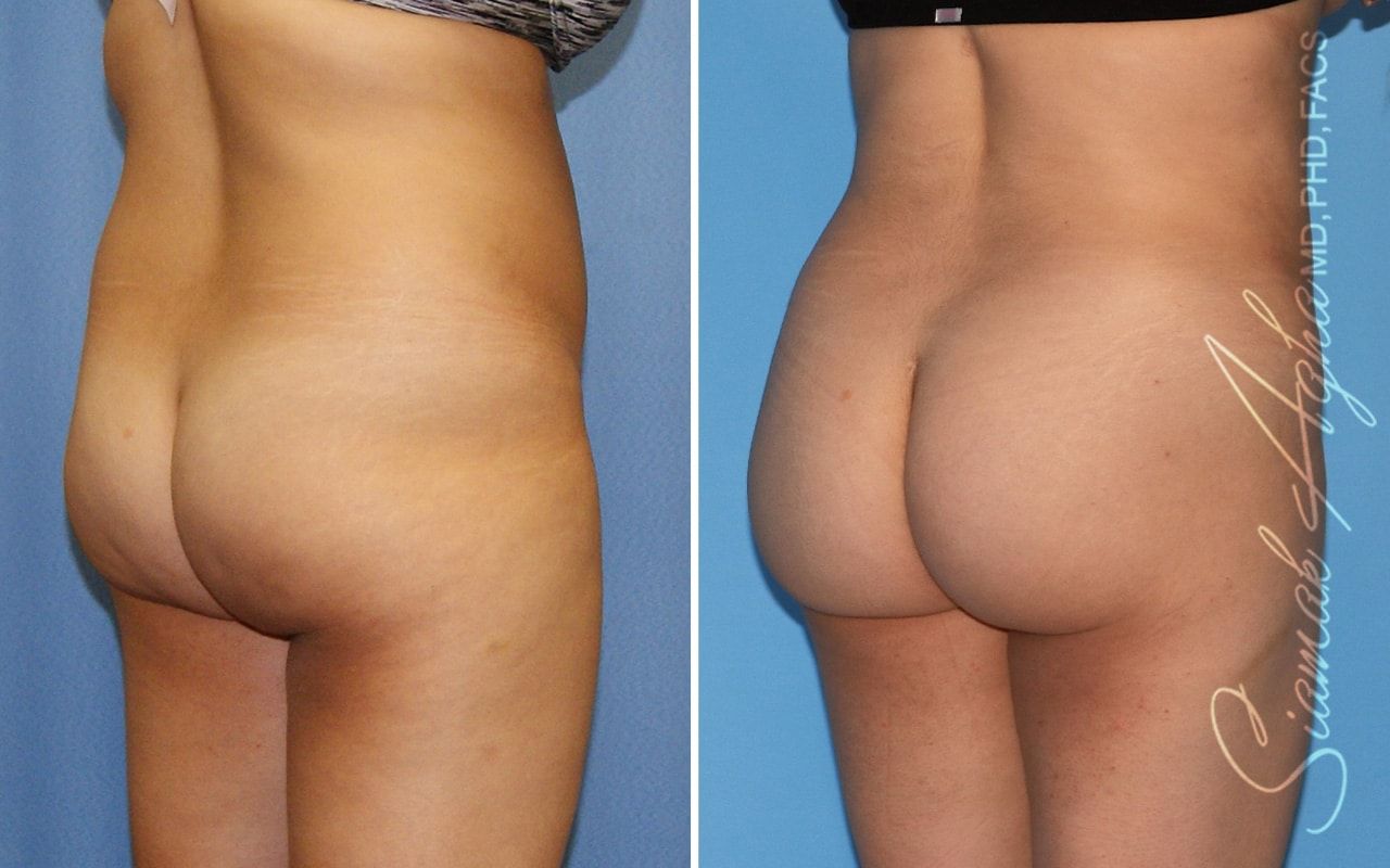 Brazilian Butt Lift Before & After