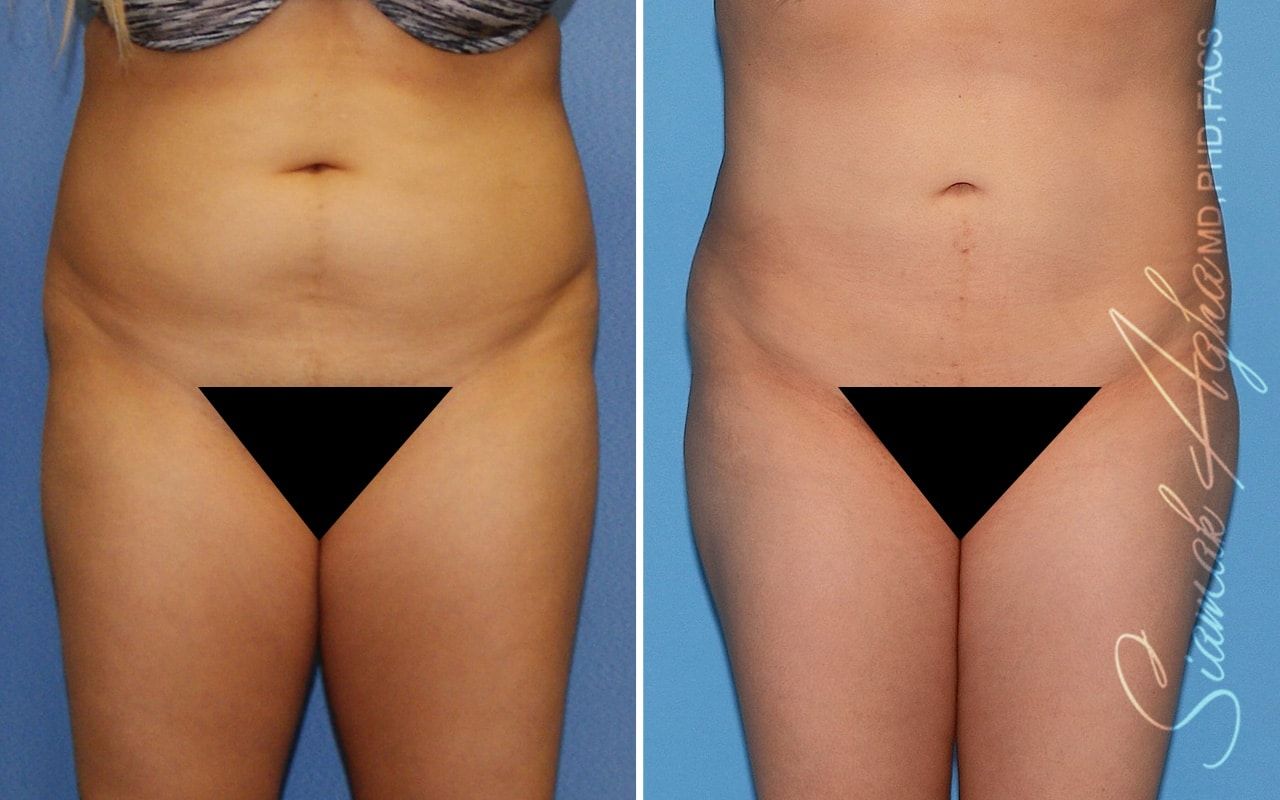 Brazilian Butt Lift Before & After