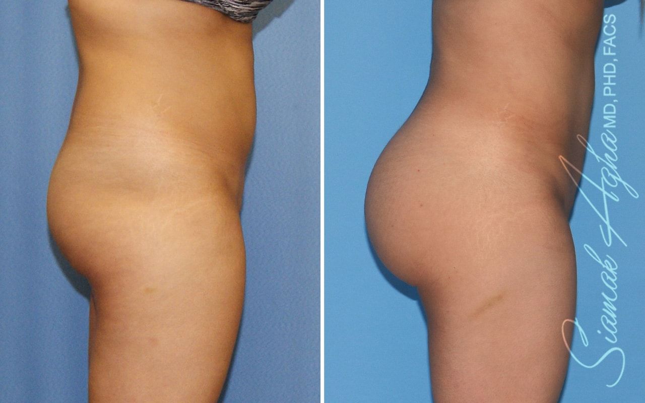 Brazilian Butt Lift Before & After