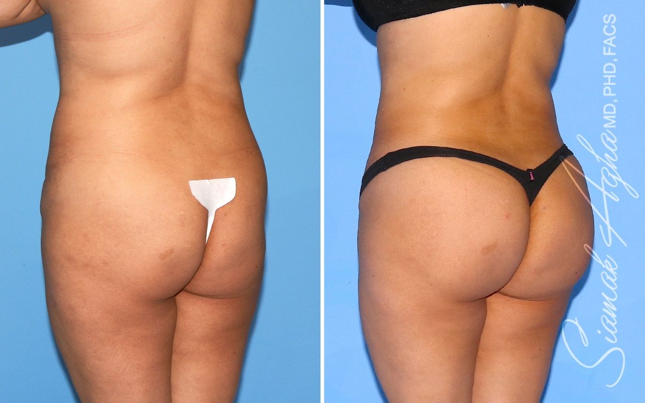 Brazilian Butt Lift Before & After