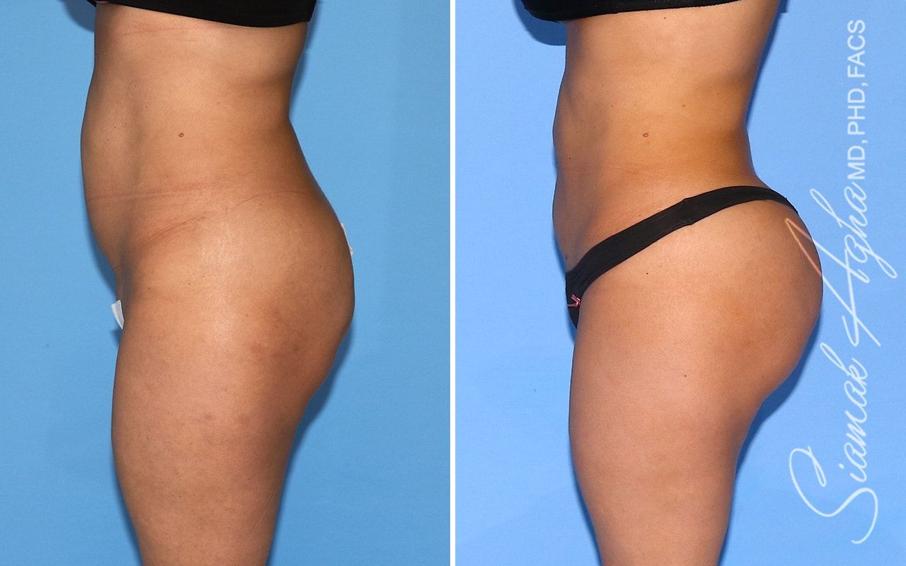 Brazilian Butt Lift Before & After