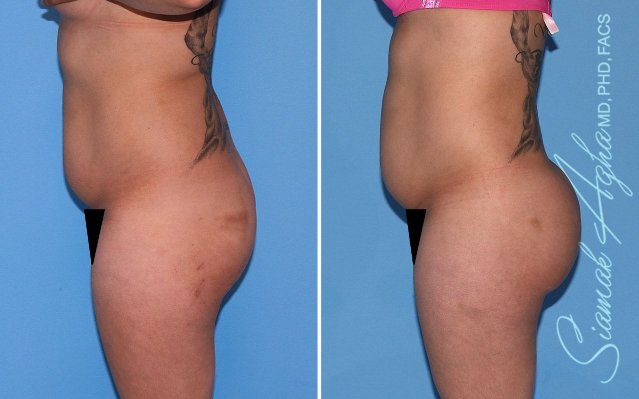 Brazilian Butt Lift Before & After
