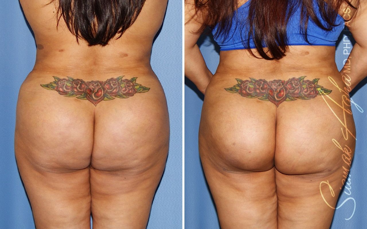 Brazilian Butt Lift Before & After