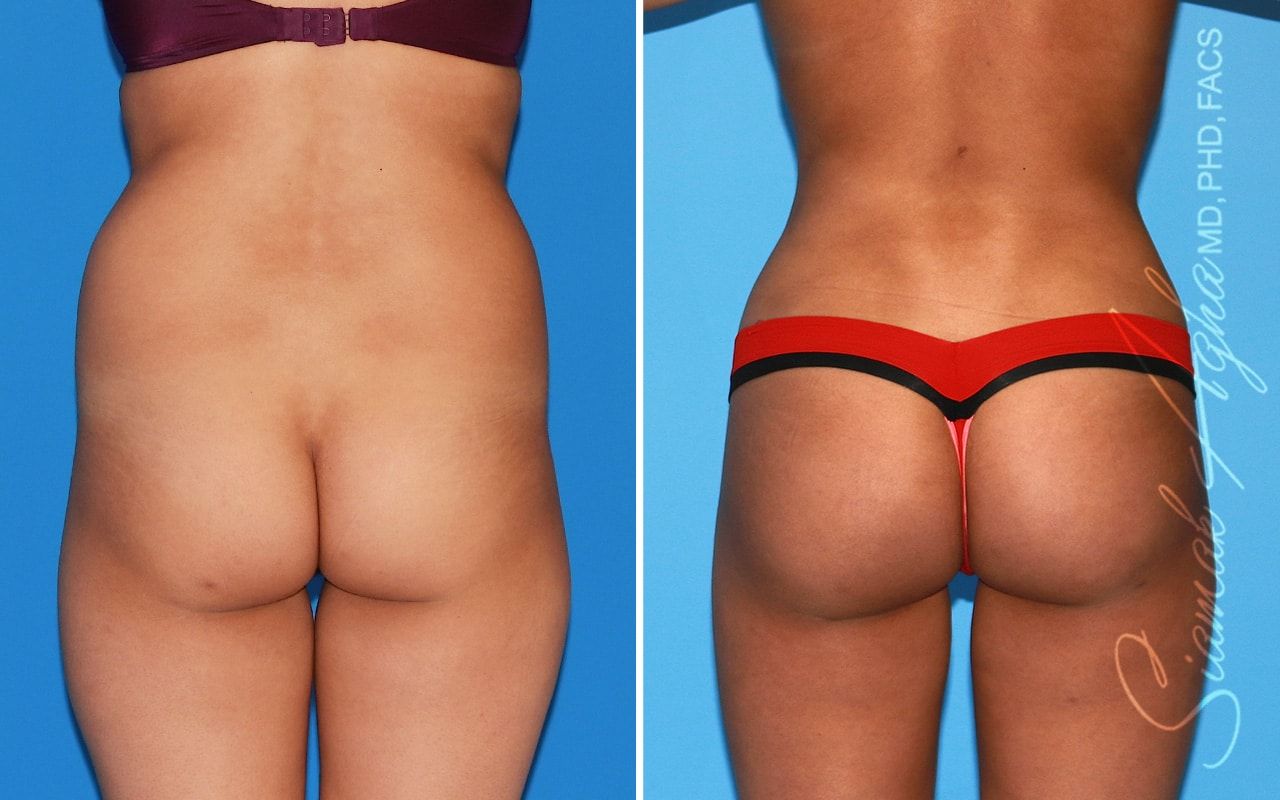 Brazilian Butt Lift Before & After