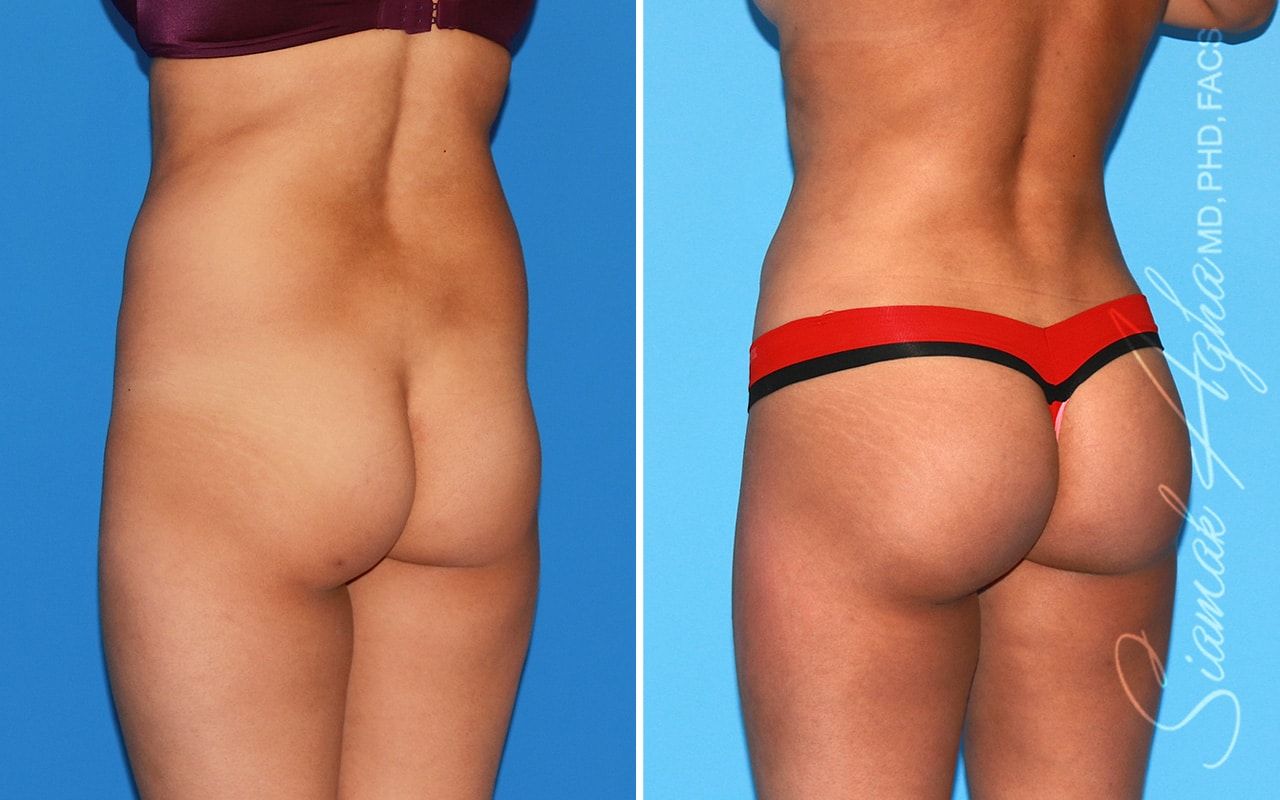 Brazilian Butt Lift Before & After