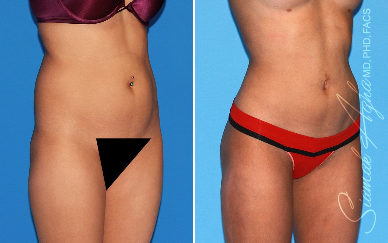 Brazilian Butt Lift Before & After