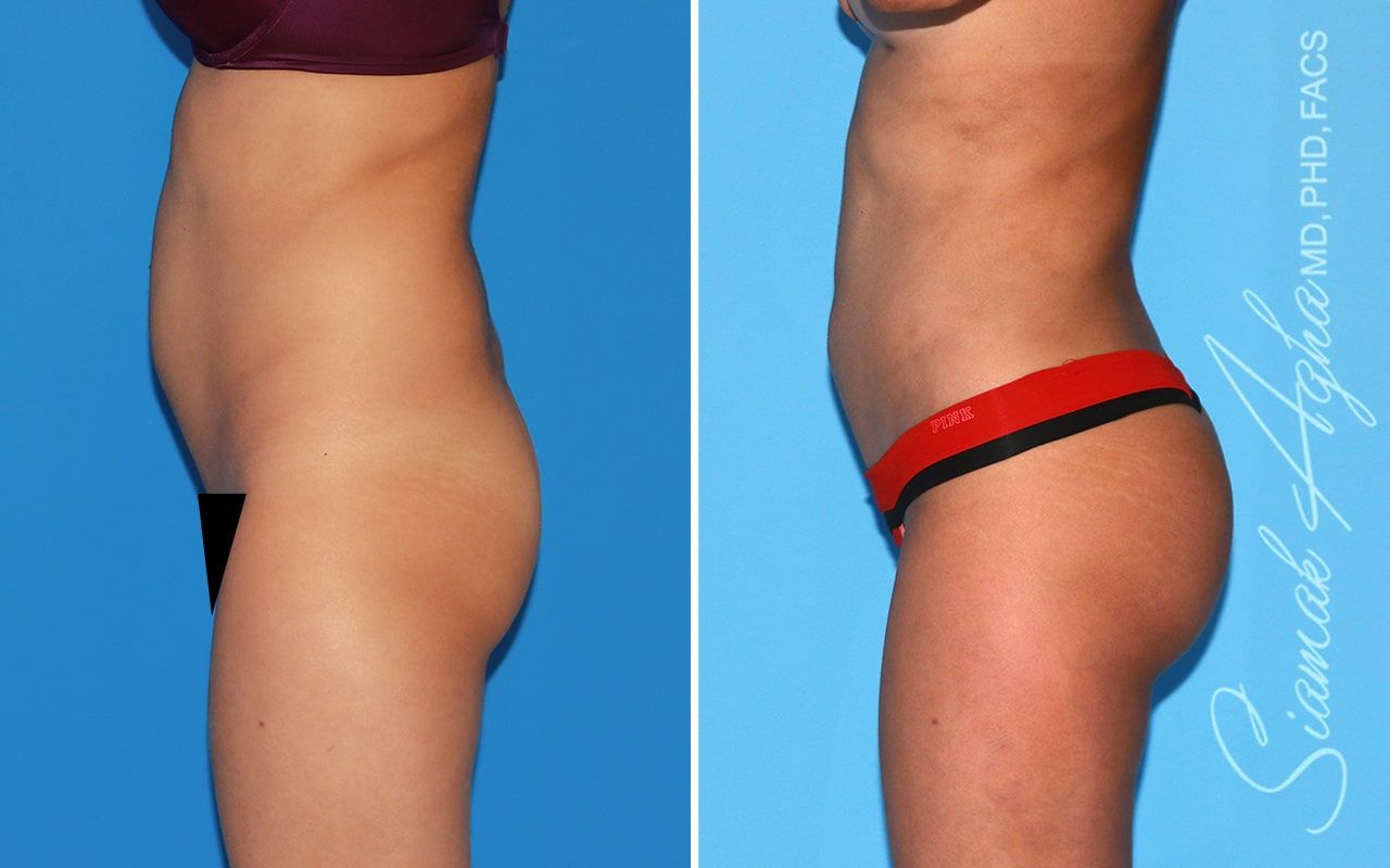 Brazilian Butt Lift Before & After