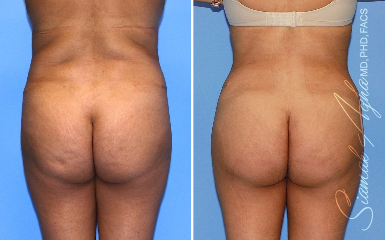 Brazilian Butt Lift Before & After