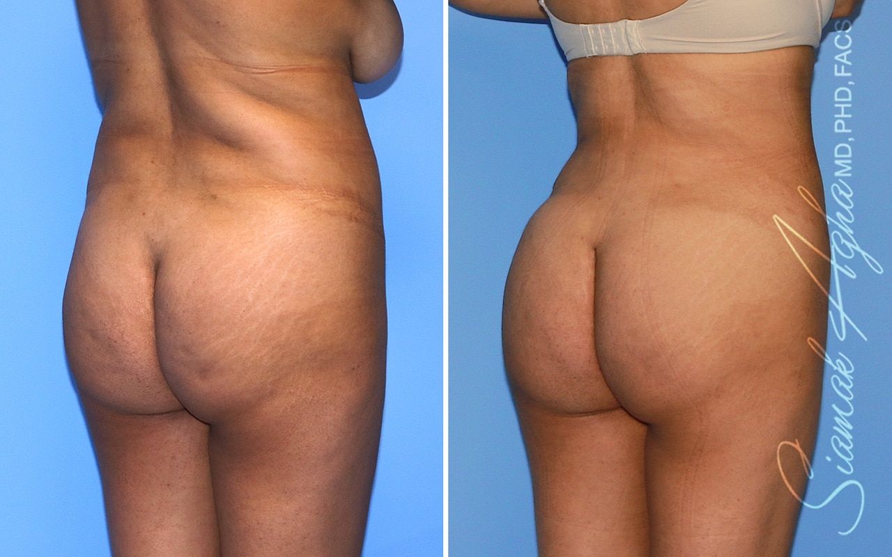Brazilian Butt Lift Before & After